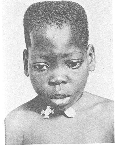 African Child with Bossed Skull feature sometimes found to be beautifull in the Igbo tribe; Edelstein, 1986: p 21